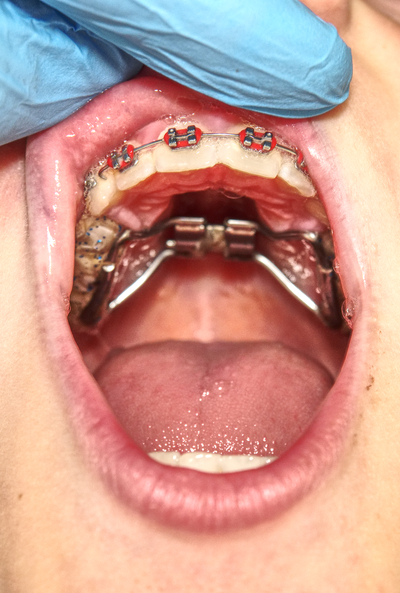 Technique multibagues orthodontie